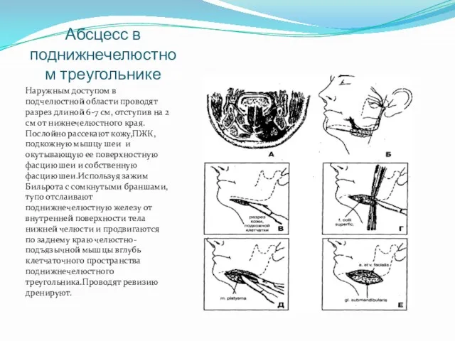 Абсцесс в поднижнечелюстном треугольнике Наружным доступом в подчелюстной области проводят