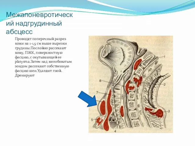 Межапоневротический надгрудинный абсцесс Проводят поперечный разрез кожи на 1-1,5 см