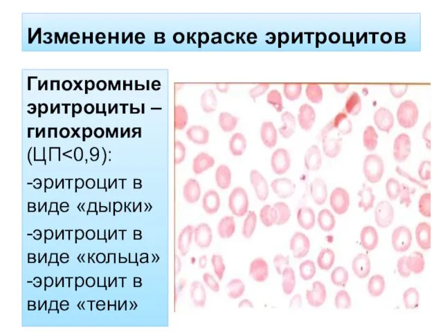 Изменение в окраске эритроцитов Гипохромные эритроциты – гипохромия (ЦП˂0,9): -эритроцит