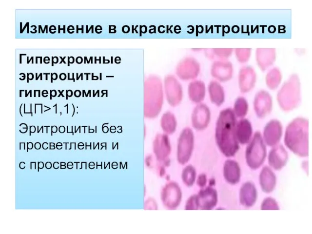 Изменение в окраске эритроцитов Гиперхромные эритроциты – гиперхромия (ЦП˃1,1): Эритроциты без просветления и с просветлением