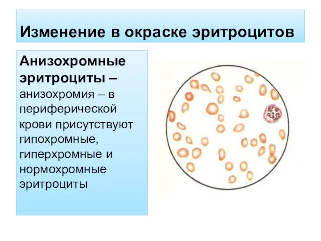 Изменение в окраске эритроцитов Анизохромные эритроциты – анизохромия – в