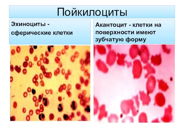 Пойкилоциты Эхиноциты - сферические клетки Акантоцит - клетки на поверхности имеют зубчатую форму