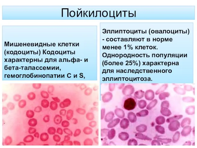 Пойкилоциты Мишеневидные клетки (кодоциты) Кодоциты характерны для альфа- и бета-талассемии,