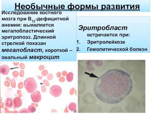 Необычные формы развития Исследование костного мозга при В12-дефицитной анемии: выявляется