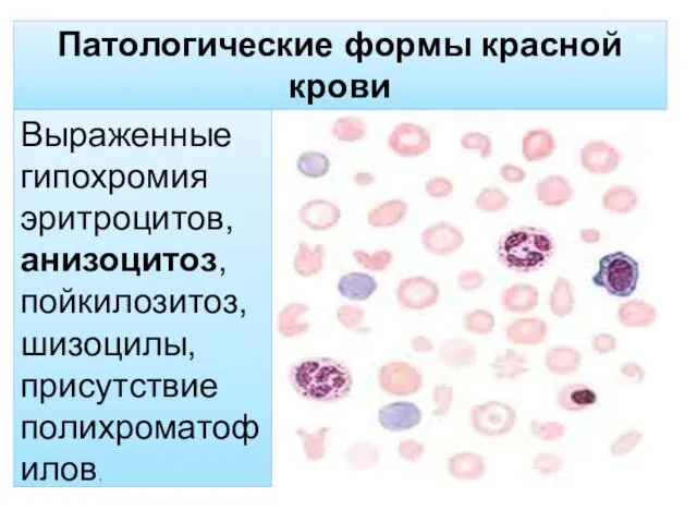 Патологические формы красной крови Выраженные гипохромия эритроцитов, анизоцитоз, пойкилозитоз, шизоцилы, присутствие полихроматофилов.