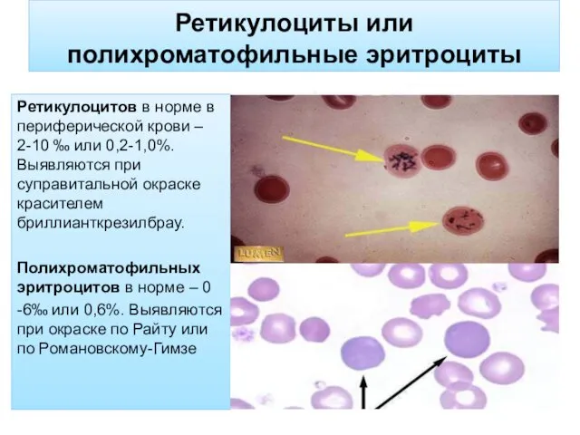 Ретикулоциты или полихроматофильные эритроциты Ретикулоцитов в норме в периферической крови