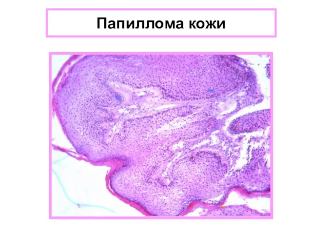 Папиллома кожи