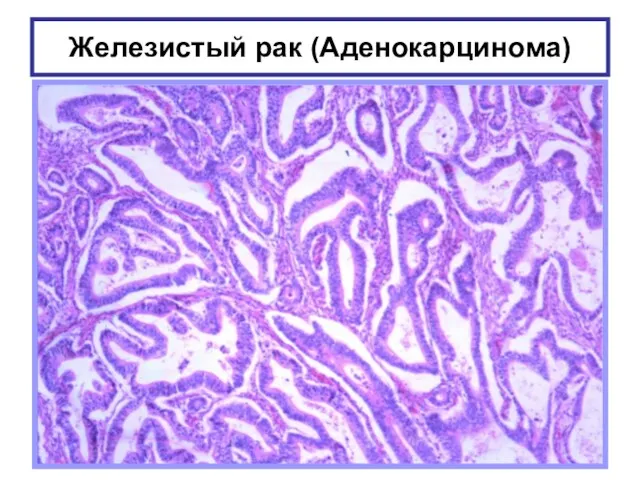 Железистый рак (Аденокарцинома)