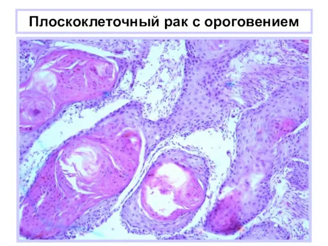 Плоскоклеточный рак с ороговением