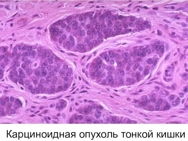 Карциноидная опухоль тонкой кишки