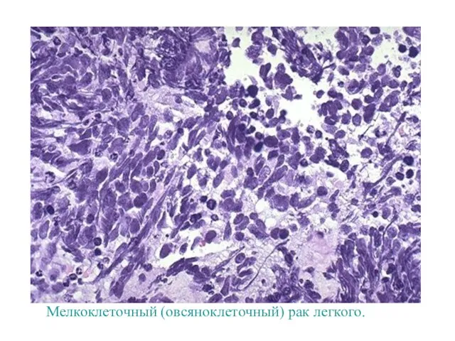 Мелкоклеточный (овсяноклеточный) рак легкого.