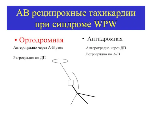 АВ реципрокные тахикардии при синдроме WPW Ортодромная Антероградно через А-В узел Ретроградно по