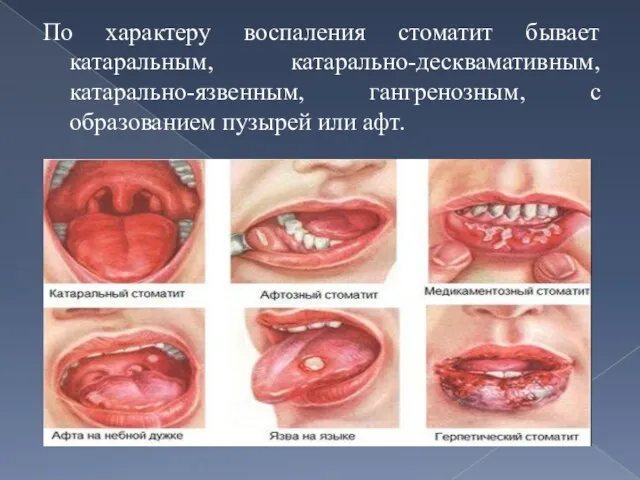 По характеру воспаления стоматит бывает катаральным, катарально-десквамативным, катарально-язвенным, гангренозным, с образованием пузырей или афт.