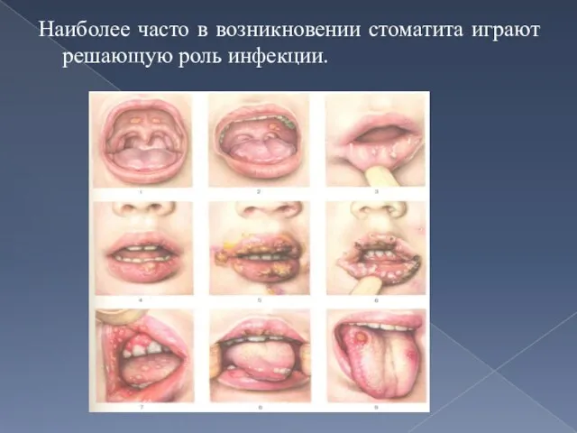 Наиболее часто в возникновении стоматита играют решающую роль инфекции.