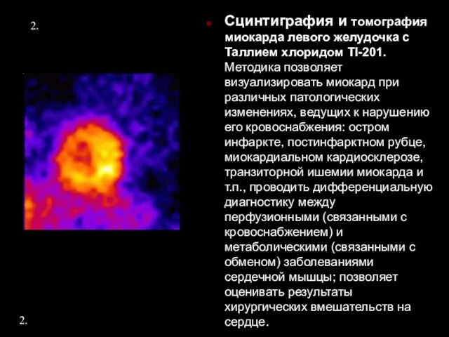 2. Сцинтиграфия и томография миокарда левого желудочка с Таллием хлоридом