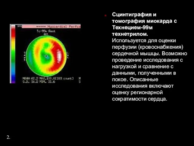 Сцинтиграфия и томография миокарда с Технецием-99м технетрилом. Используется для оценки