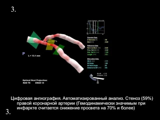 3. Цифровая ангиография. Автоматизированный анализ. Стеноз (59%) правой коронарной артерии