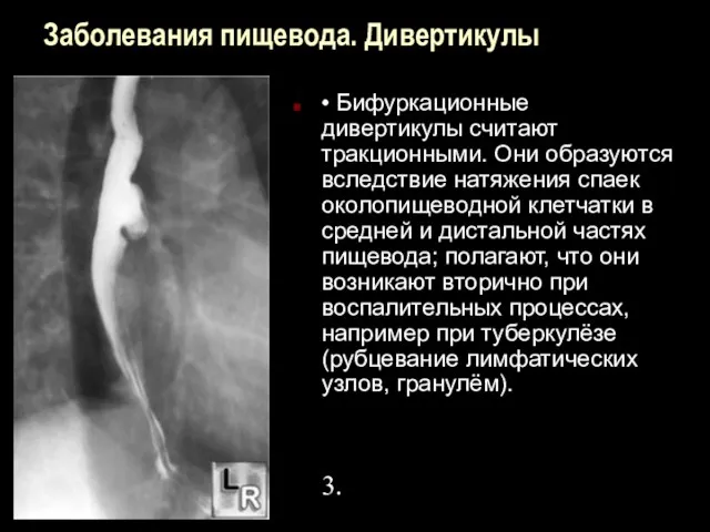 Заболевания пищевода. Дивертикулы • Бифуркационные дивертикулы считают тракционными. Они образуются