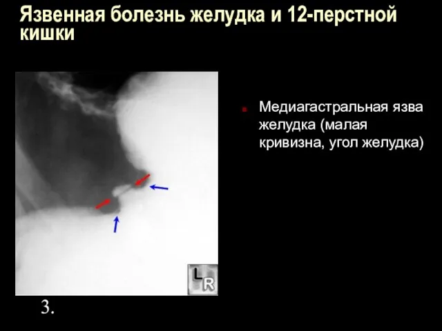 Язвенная болезнь желудка и 12-перстной кишки Медиагастральная язва желудка (малая кривизна, угол желудка) 3.