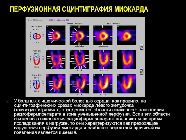 ПЕРФУЗИОННАЯ СЦИНТИГРАФИЯ МИОКАРДА У больных с ишемической болезнью сердца, как