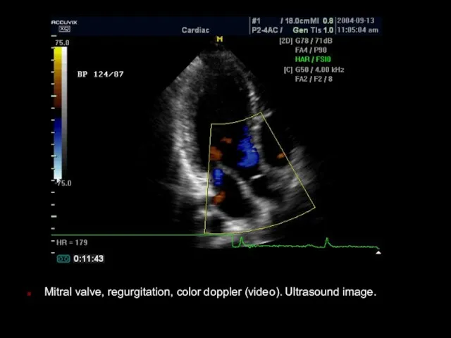 Mitral valve, regurgitation, color doppler (video). Ultrasound image.