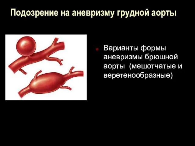 Подозрение на аневризму грудной аорты Варианты формы аневризмы брюшной аорты (мешотчатые и веретенообразные)