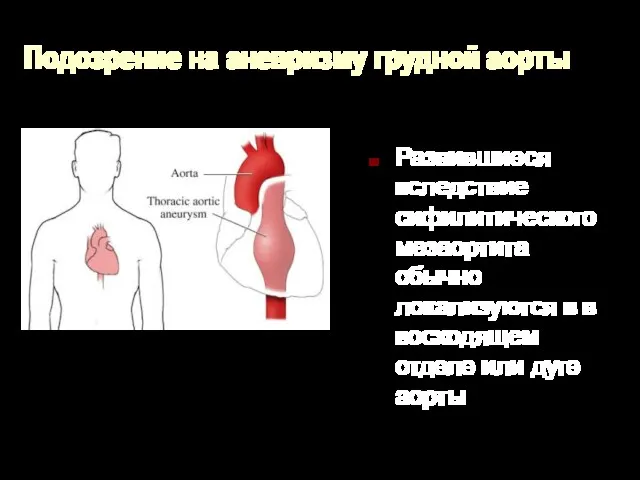 Подозрение на аневризму грудной аорты Развившиеся вследствие сифилитического мезаортита обычно