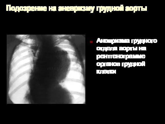 Подозрение на аневризму грудной аорты Аневризма грудного отдела аорты на рентгенограмме органов грудной клетки