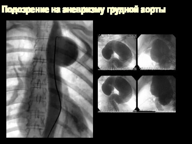 Подозрение на аневризму грудной аорты