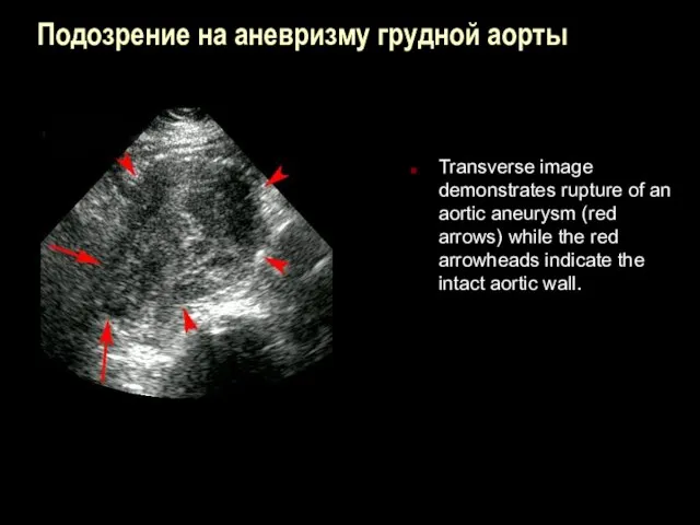 Подозрение на аневризму грудной аорты Transverse image demonstrates rupture of