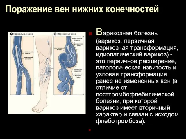 Поражение вен нижних конечностей Варикозная болезнь (варикоз, первичная варикозная трансформация,