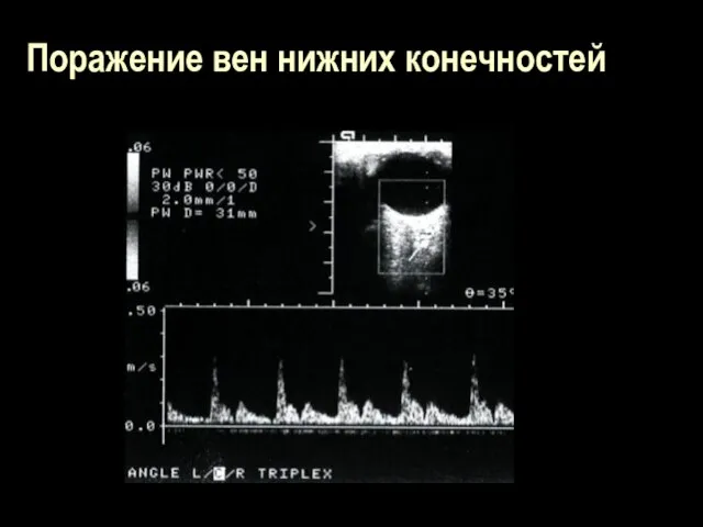 Поражение вен нижних конечностей