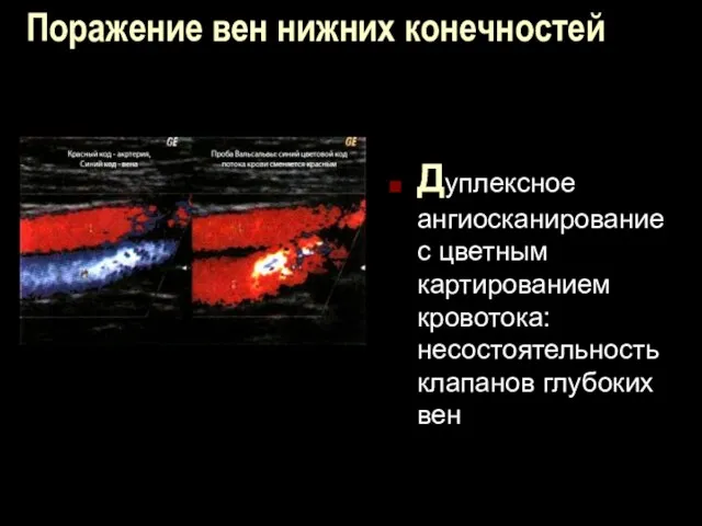 Поражение вен нижних конечностей Дуплексное ангиосканирование с цветным картированием кровотока: несостоятельность клапанов глубоких вен