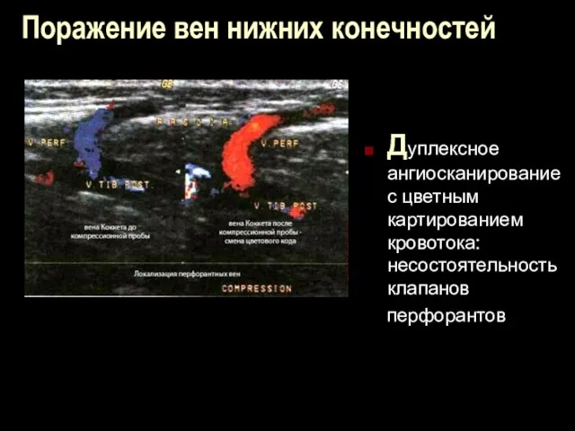 Поражение вен нижних конечностей Дуплексное ангиосканирование с цветным картированием кровотока: несостоятельность клапанов перфорантов