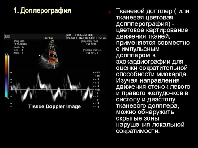 1. Доплерография Тканевой допплер ( или тканевая цветовая допплерография) -