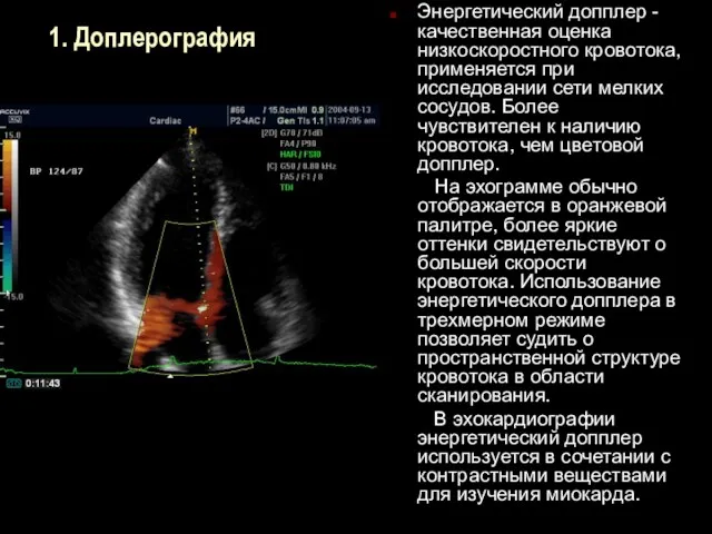 1. Доплерография Энергетический допплер - качественная оценка низкоскоростного кровотока, применяется