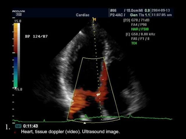 1. Heart, tissue doppler (video). Ultrasound image. 1.