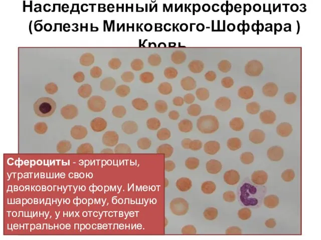 Наследственный микросфероцитоз (болезнь Минковского-Шоффара ) Кровь. Сфероциты - эритроциты, утратившие свою двояковогнутую форму.
