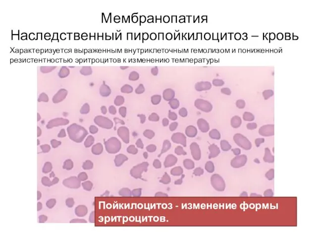 Мембранопатия Наследственный пиропойкилоцитоз – кровь Характеризуется выраженным внутриклеточным гемолизом и пониженной резистентностью эритроцитов