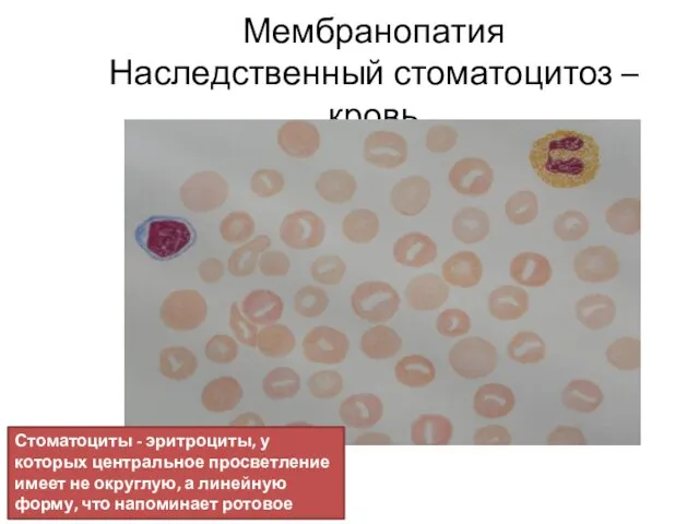 Мембранопатия Наследственный стоматоцитоз – кровь Стоматоциты - эритроциты, у которых