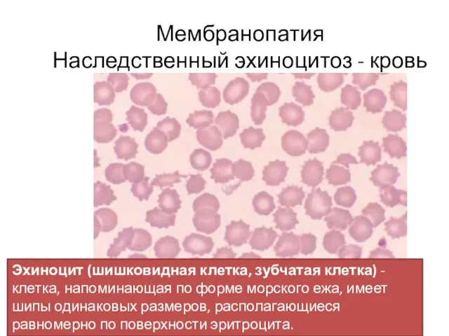 Мембранопатия Наследственный эхиноцитоз - кровь Эхиноцит (шишковидная клетка, зубчатая клетка)