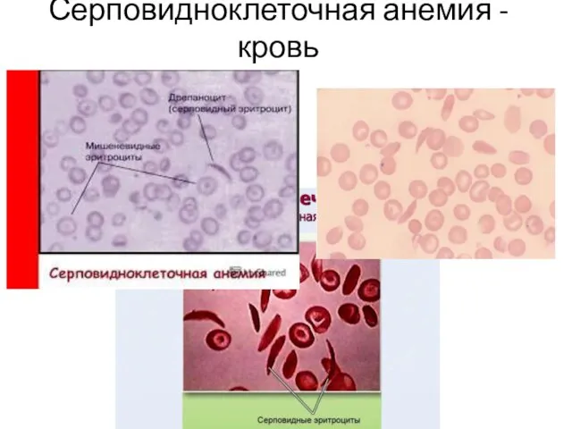 Серповидноклеточная анемия - кровь