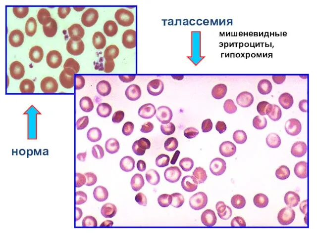 мишеневидные эритроциты, гипохромия