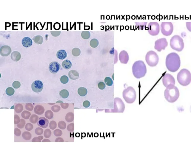 РЕТИКУЛОЦИТЫ полихроматофильные эритроциты нормоциты