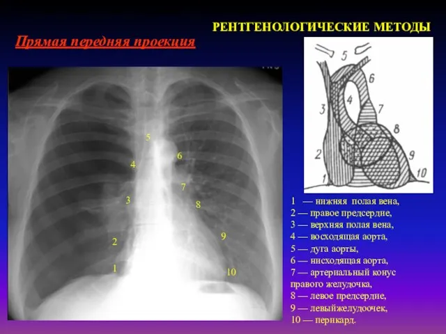 Лучевая диагностика заболеваний сердечно-сосудистой системы РЕНТГЕНОЛОГИЧЕСКИЕ МЕТОДЫ Прямая передняя проекция