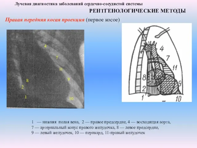 Лучевая диагностика заболеваний сердечно-сосудистой системы РЕНТГЕНОЛОГИЧЕСКИЕ МЕТОДЫ Правая передняя косая