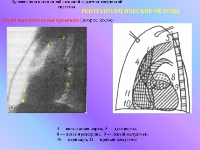 Лучевая диагностика заболеваний сердечно-сосудистой системы РЕНТГЕНОЛОГИЧЕСКИЕ МЕТОДЫ Левая передняя косая