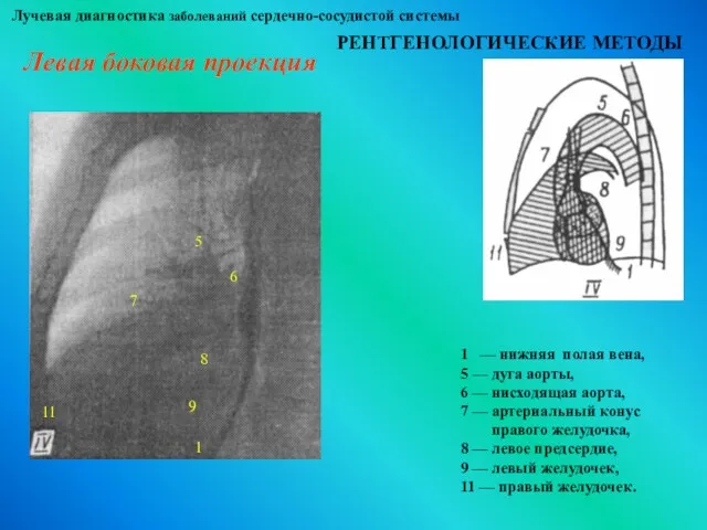 Лучевая диагностика заболеваний сердечно-сосудистой системы РЕНТГЕНОЛОГИЧЕСКИЕ МЕТОДЫ Левая боковая проекция