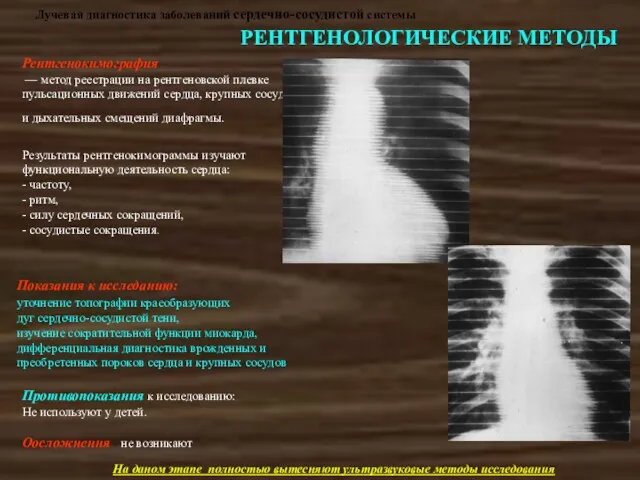 Лучевая диагностика заболеваний сердечно-сосудистой системы РЕНТГЕНОЛОГИЧЕСКИЕ МЕТОДЫ Рентгенокимография — метод