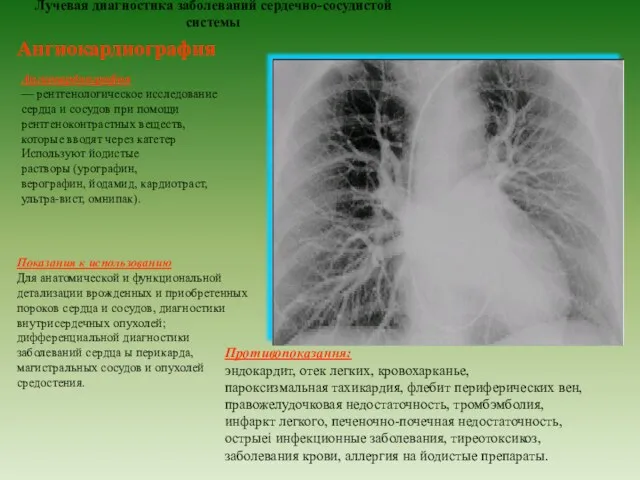 Лучевая диагностика заболеваний сердечно-сосудистой системы Ангиокардиография Ангиокардиография — рентгенологическое исследование